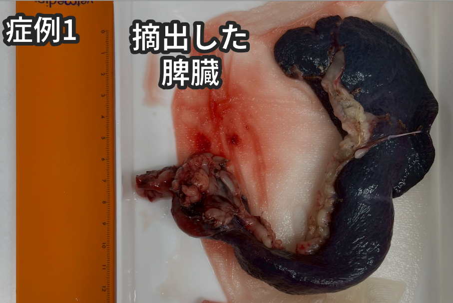 摘出した脾臓の写真