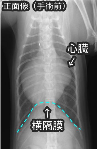 手術前の正面像の胸部レントゲン