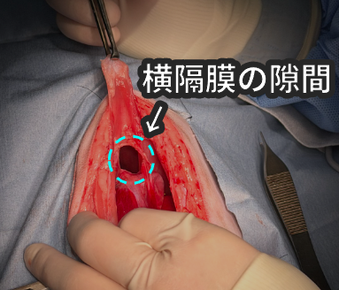 手術中に横隔膜の隙間を確認している様子
