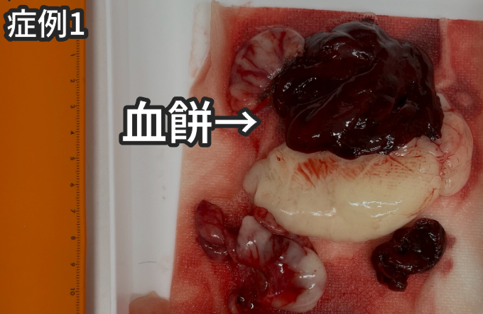 血餅の写真