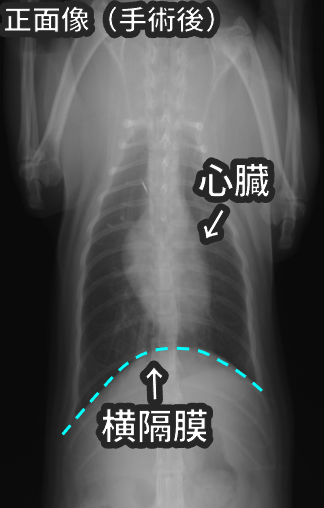 手術後の正面像のレントゲン写真